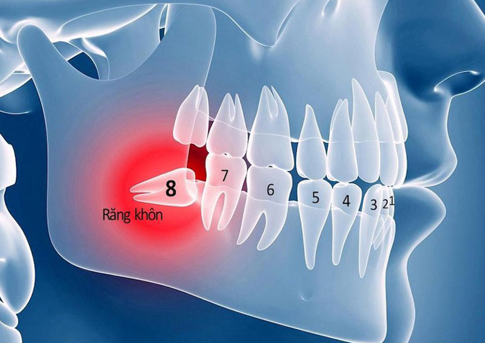 vị trí răng khôn